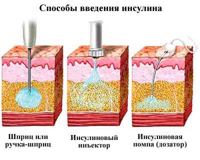Способы введения инсулина