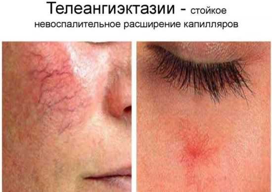 Стойкое расширение капилляров