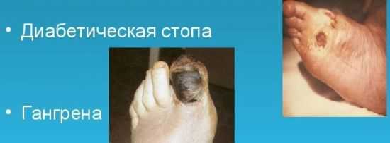 Диабетическая стопа и гангрена
