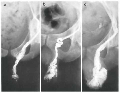 Стадии варикоцеле на рентгенограмме Стадии варикоцеле на рентгенограмме