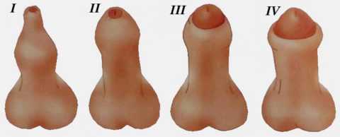 Степени фимоза Степени фимоза