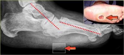 Стопа Шарко с костной деформацией и переломом Стопа Шарко с костной деформацией и переломом
