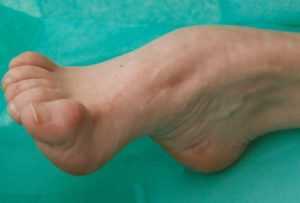 Стопа Шарко при сахарном диабете