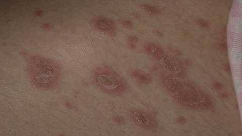 Стригущий лишай при СД