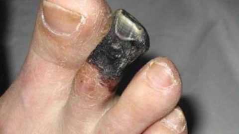 Сухая гангрена пальца стопы