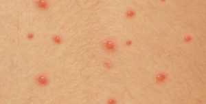 Сыпь и высыпания при сахарном диабете