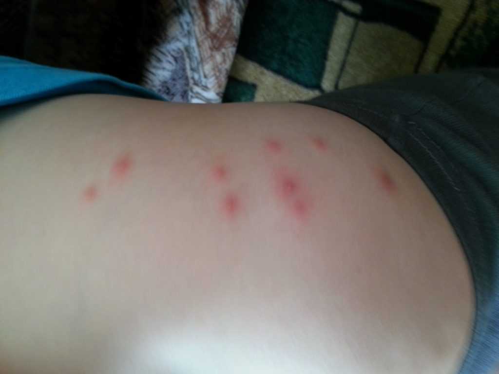 Диабетическая дермопатия