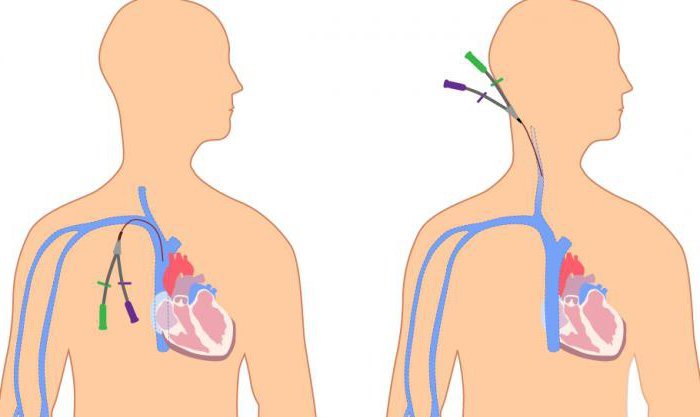 Постановка катетора в подключинную и яремную вены