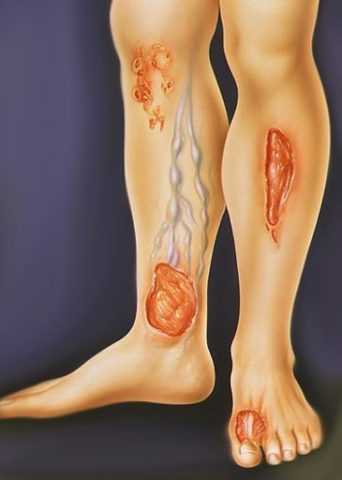 Трофическая язва. Трофическая язва.