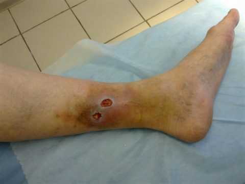 Трофическая язва на ноге Трофическая язва на ноге