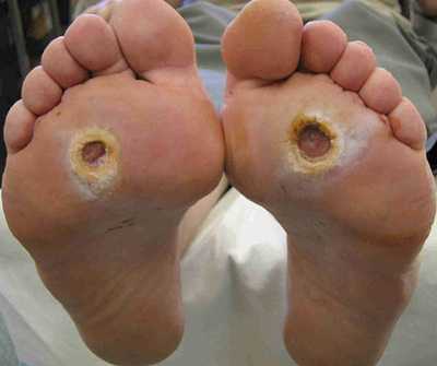 Тяжелая форма флегмоны стопы