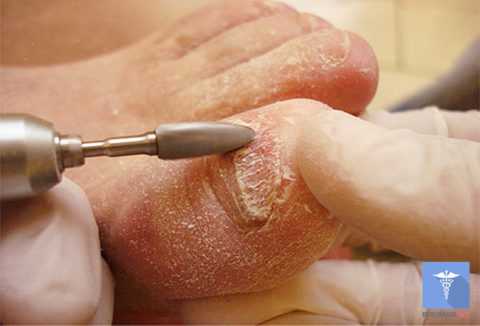 Удаление ногтя при грибковом поражении. Удаление ногтя при грибковом поражении.