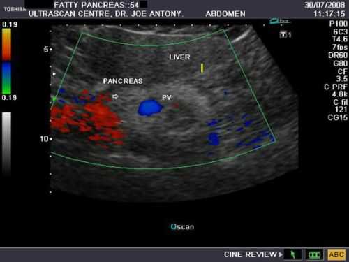 Диффузные изменения в тканях поджелудочной
