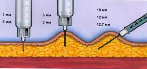 В зависимости от длины иглы, инсулин вводится под кожу под прямым углом или под углом 45 градусов. В зависимости от длины иглы, инсулин вводится под кожу под прямым углом или под углом 45 градусов.