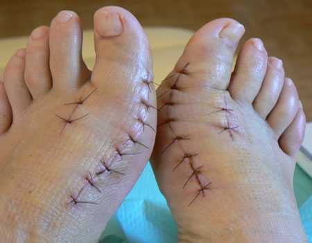 Вальгусная деформация стопы