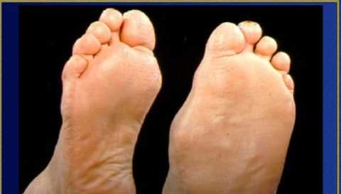 Вариант диабетической стопы Шарко Вариант диабетической стопы Шарко