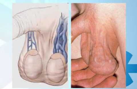 Варикозное расширение вен яичка и семенного канатика Варикозное расширение вен яичка и семенного канатика