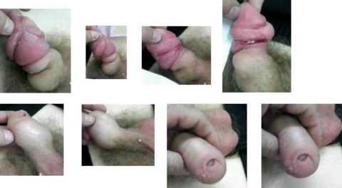 Вид полового органа при парафимозе Вид полового органа при парафимозе