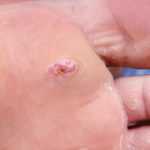 Вид стопы на первой стадии