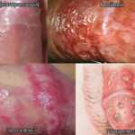 Виды и формы баланопостита