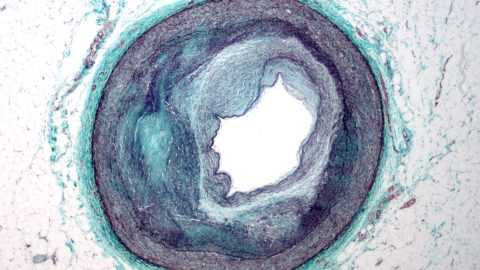 Внутренняя оболочка сосудов при диабете утолщается и отекает