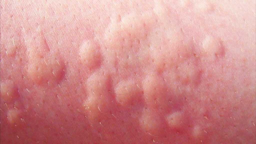 Диабетические волдыри