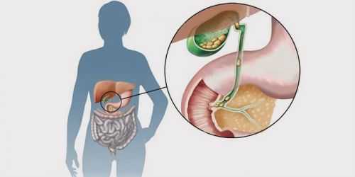 Камни в желчном пузыре