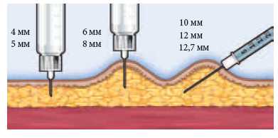 Введение при различной длине иглы Введение при различной длине иглы