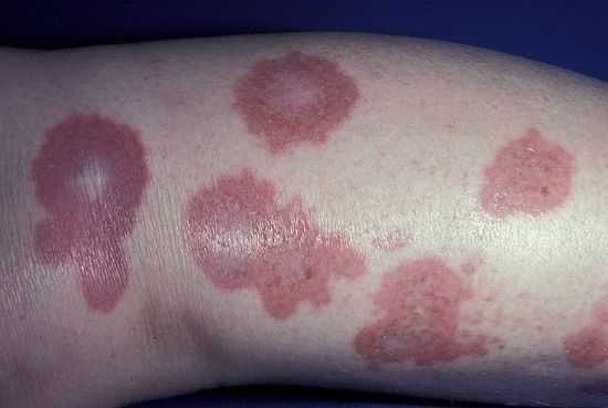 Некробиоз липоидный диабетический