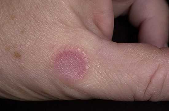 Кольцевидная гранулема