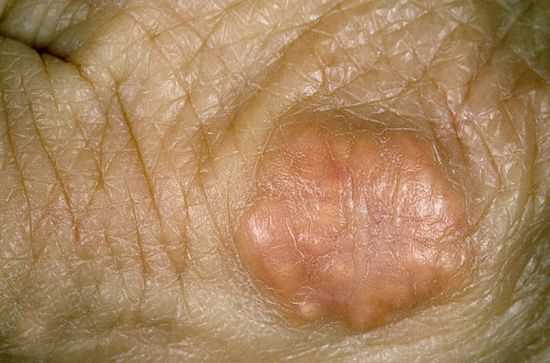 Ксантоматоз