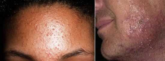 Пиодермия диабетическая