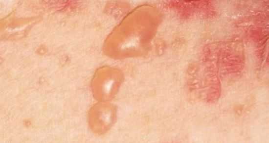 Пузырчатка