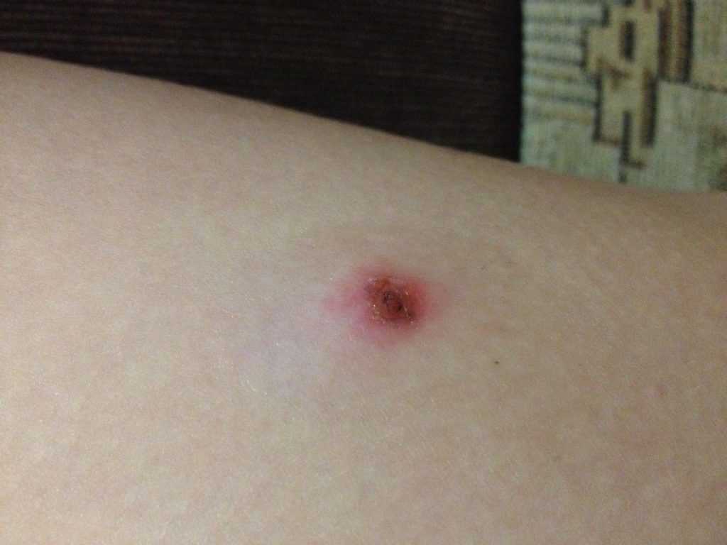 Диабетическая язва