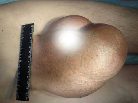 Запущенная стадия орхита Запущенная стадия орхита