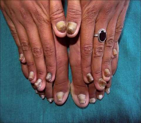 Запущенный грибок на руках и ногах. Запущенный грибок на руках и ногах.