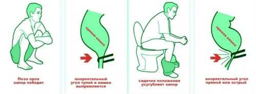 Правильная поза для дефекации