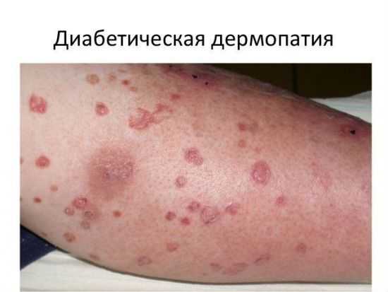 Диабетическая дермопатия