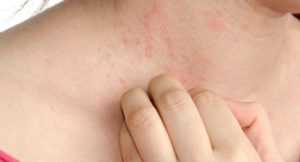 Зуд при сахарном диабете